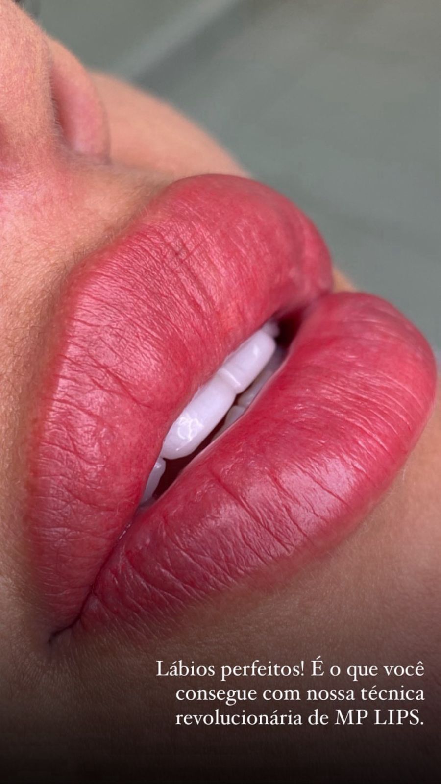 Resultado de micropigmentação labial
