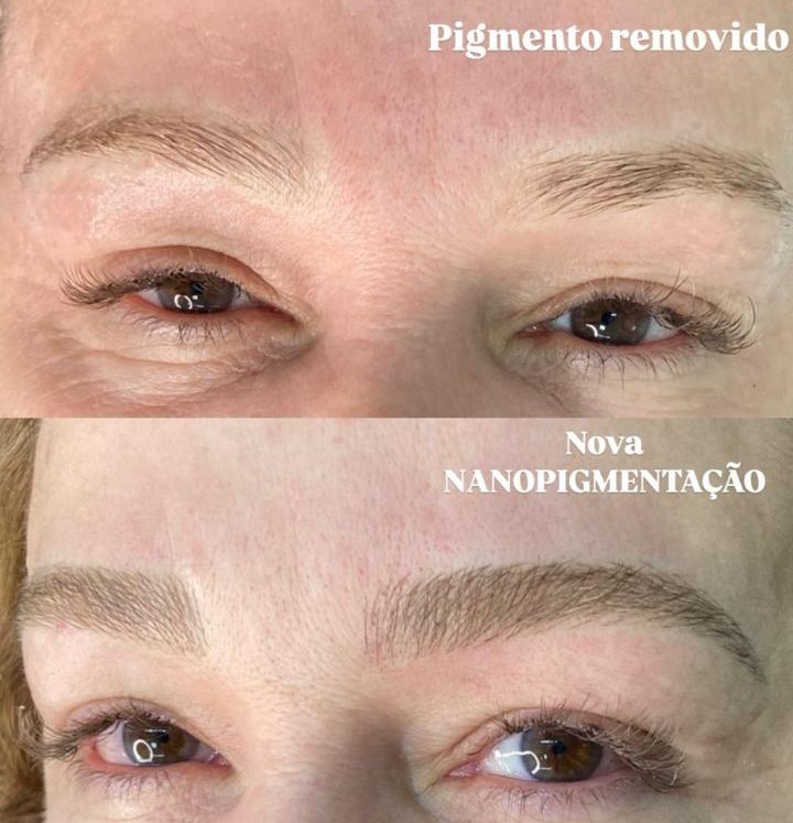 Resultado de remoção de pigmento a laser
